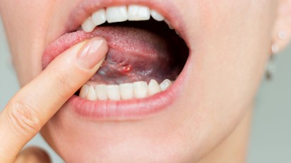 A nyelve is árulkodhat: 9 szájüregi tünet, amely B12-vitamin-hiányra figyelmeztethet című cikk nyitóképe