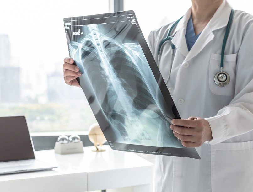 koronavírus, tüdő, tüdőbetegség, covid-19