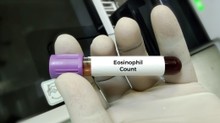 Mitől lehet magas a eosinophil a vérképben? Ezeket mindenképp tudnia kell! című cikk nyitóképe