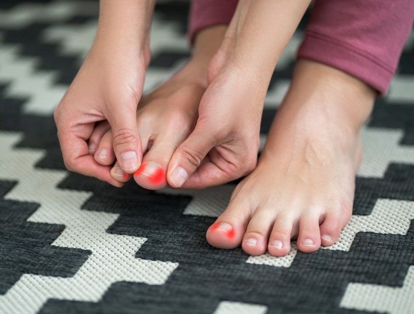 körömágy-gyulladás, oka, tünetei, kezelése, bőrbetgegség, baktérium, gomba