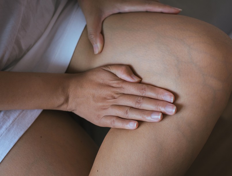 Trombózis után szövődmény PTS tüdőembólia