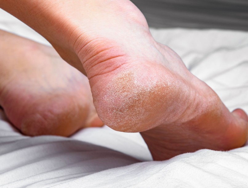 Kirepedezett sarok kezelése veszély