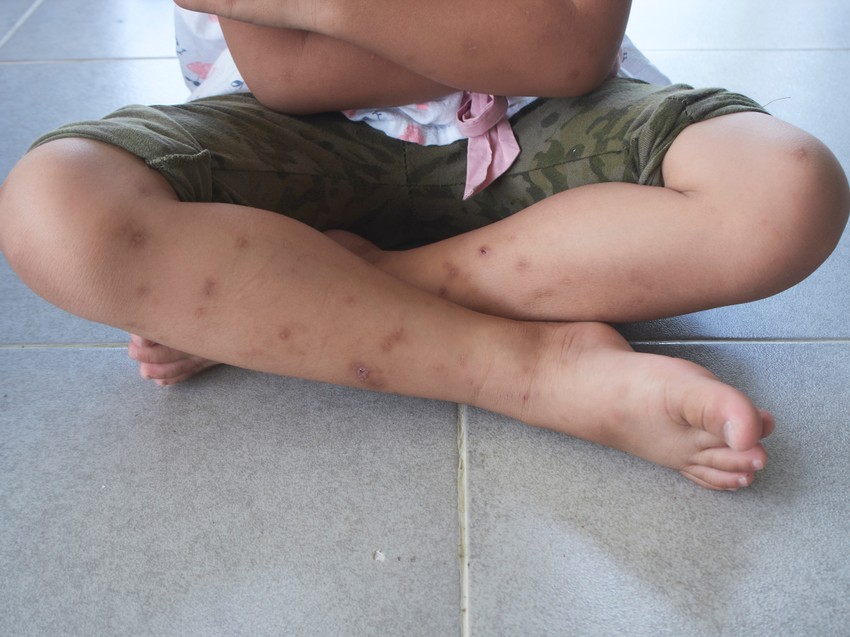 A betegség hirtelen magas lázzal, izületi és izom és csontfájdalommal, hányással kezdődik, esetleg halvány kiütéssel jár. Mérsékelt vérzékenység (orr-, ínyvérzés) kísérheti a betegséget, mely 3 -10 napig tart. A lábadozás lassú, hetekig tarthat, fáradékonysággal, izomgyengeséggel jár. Ismételt fertőzés esetén, súlyos vérzéses formában lép fel.