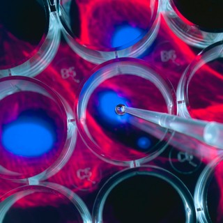 HIV: egy különleges eljárásnak köszönhetően egy 53 éves férfi kigyógyult a betegségből című cikk nyitóképe