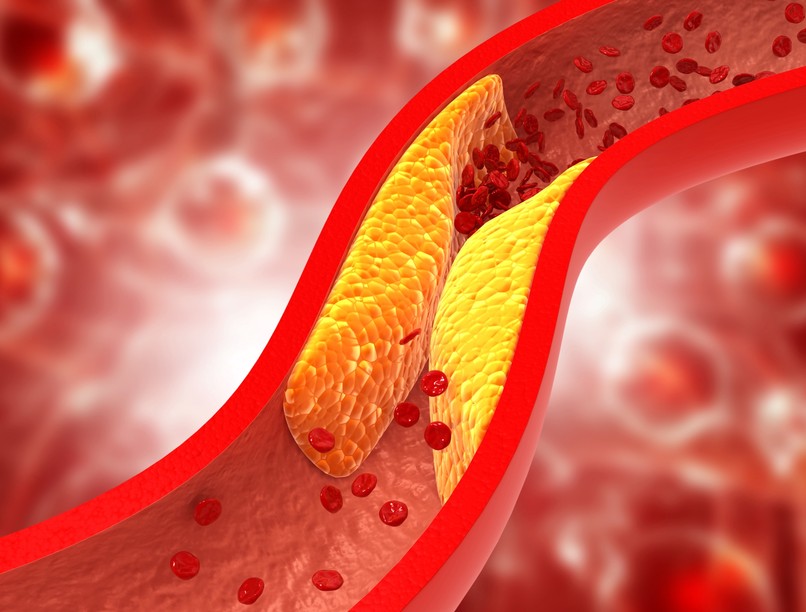 magas koleszterinszint koleszterin ellen módszerek LDL HDL