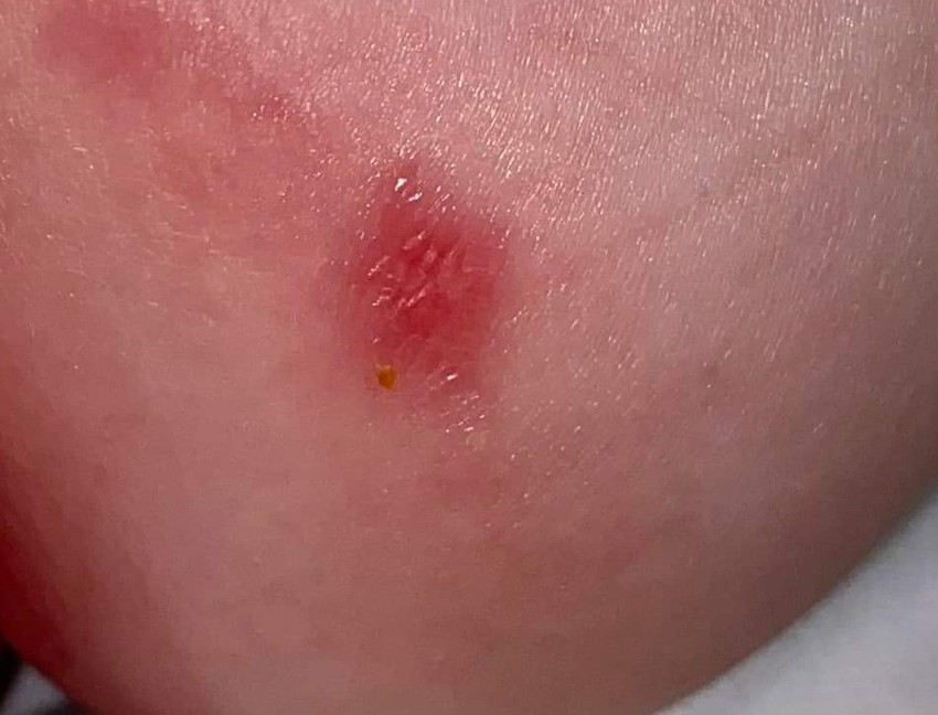 Ekcéma szerű, kicsit hólyagos, hámló kiütések a gyerek bőrén