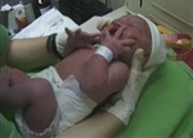 A császármetszés nem befolyásolja a szoptatás időtartamát