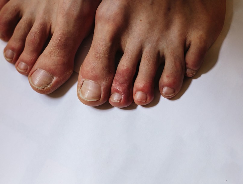 covid lábujj, koronavírus