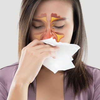 Visszatérő arcüreggyulladás: orrpolip és reflux is állhat a háttérben című cikk nyitóképe