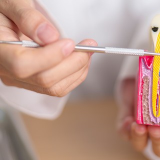 A fogszuvasodás oka, tünetei és kezelési lehetőségei című cikk nyitóképe