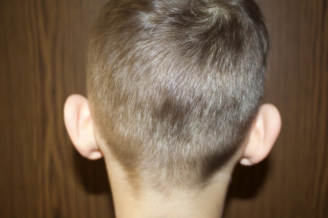 A kisfiamat csúfolják az elálló fülei miatt, van valami eszköz, ami segíthetne? Az orvos válaszol