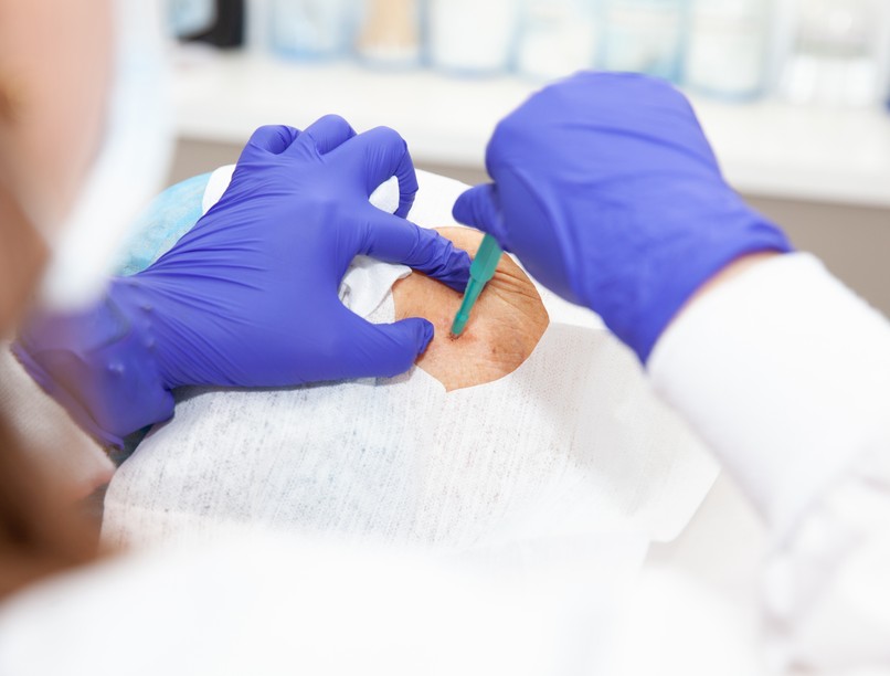 bőrbiopszia szövettan mit mutat ki