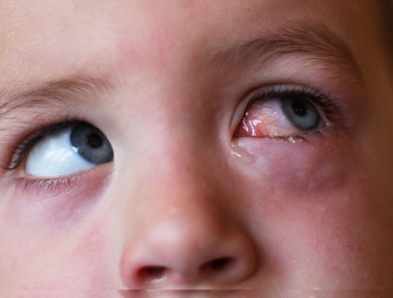 az orvos válaszol, kötőhártya-gyulladás ellen