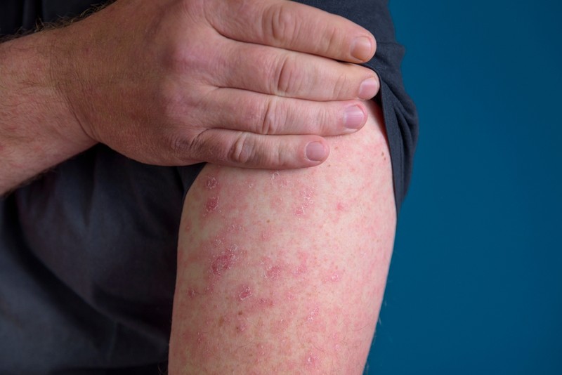 Bőr alatti meszes csomók: ilyen komoly autoimmun betegség állhat mögötte