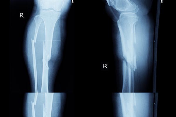 A csonttörés felismerésében a számítógép és az orvosok egyforma hatékonysággal dolgoztak