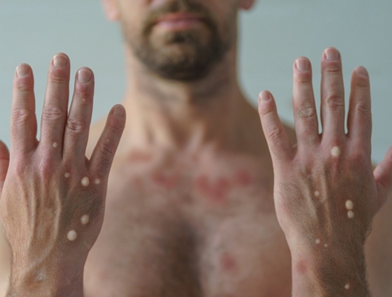 majomhimlő, majomhimlő tünetei, végbélfájdalom, pénisz duzzanat, fertőző betegség, vírus