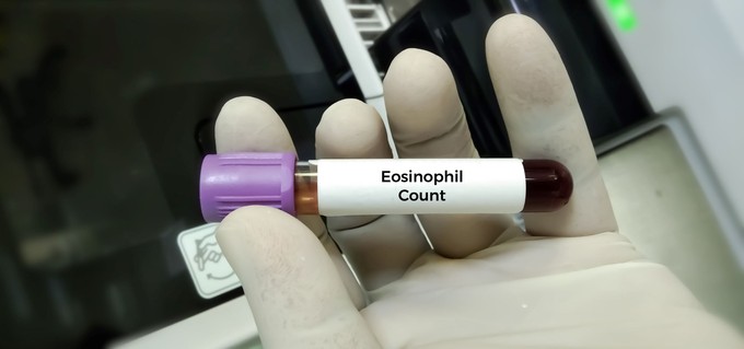 Mitől lehet magas a eosinophil a vérképben? Ezeket mindenképp tudnia kell! című cikk nyitóképe