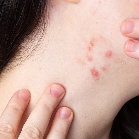 Pattanások a nyakon: nem véletlenül jelennek meg – ezt üzenheti a szervezete című cikk nyitóképe