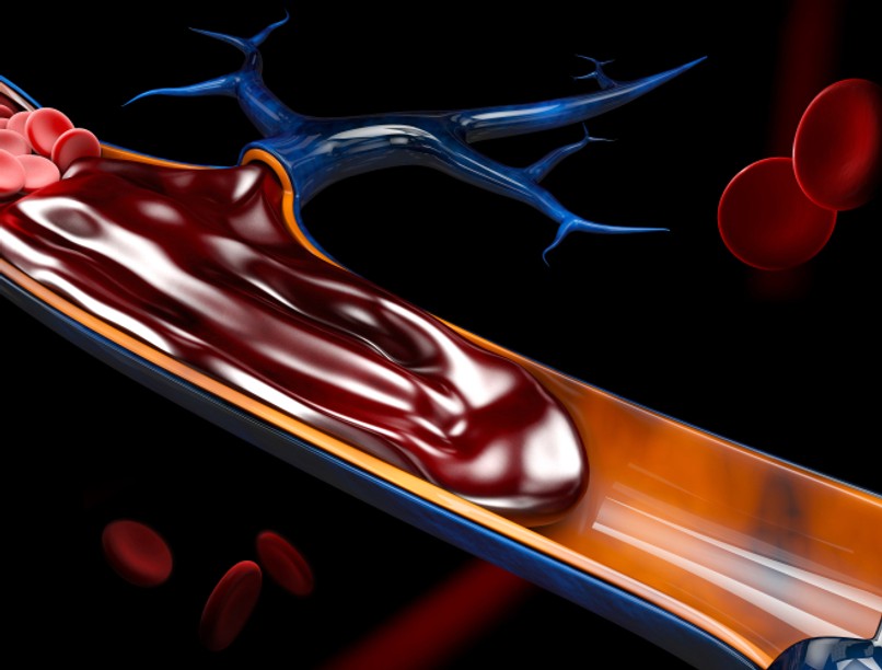 koronavírus, covid-19, tüdőembólia, koronavírus szövődménye, egészségügy