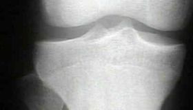 Az oszteoid oszteóma a csontok jóindulatú, azaz nem rákos daganata, amely leginkább gyermekeket és fiatal felnőtteket érint. Fő tünete a fájdalom, ami általában éjszaka jelentkezik, és nem szteroid gyulladáscsökkentők (NSAID-ok) bevételére enyhül. 