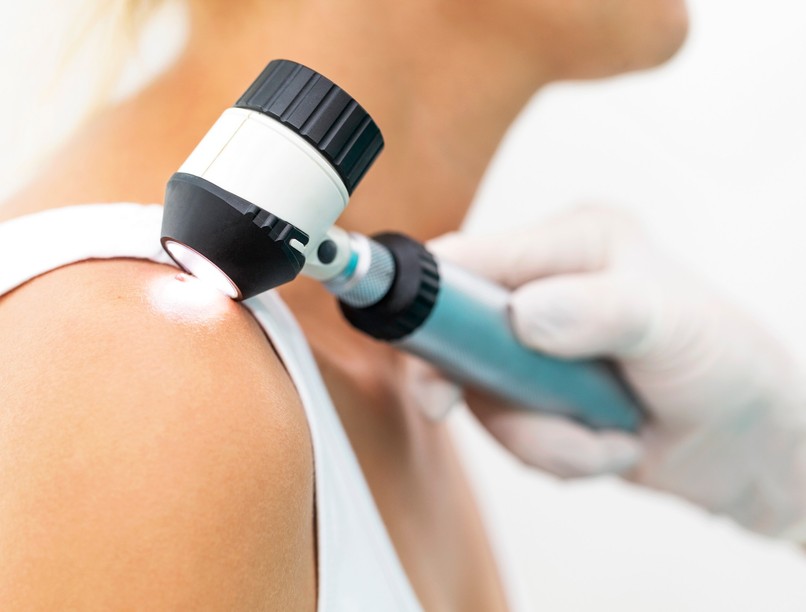 Melanóma anyajegy bőrrák tünet jel