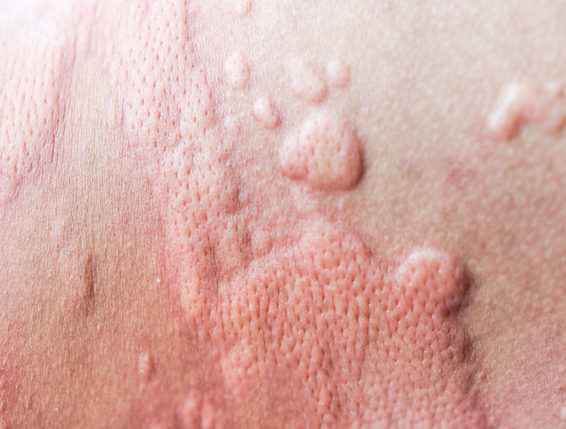 csalánkiütés esti