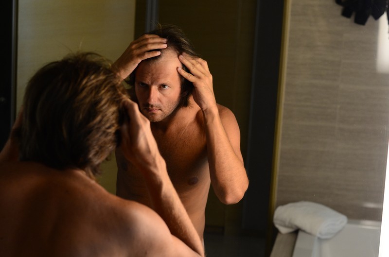 Hajhullás: megvan az ellenszer a férfiönbizalmat romboló kopaszodás ellen?