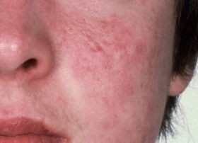 Túl tiszta környezet = depresszió?