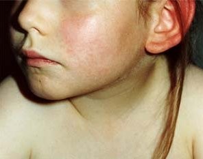 Ötödik betegség: erythema infectiosum