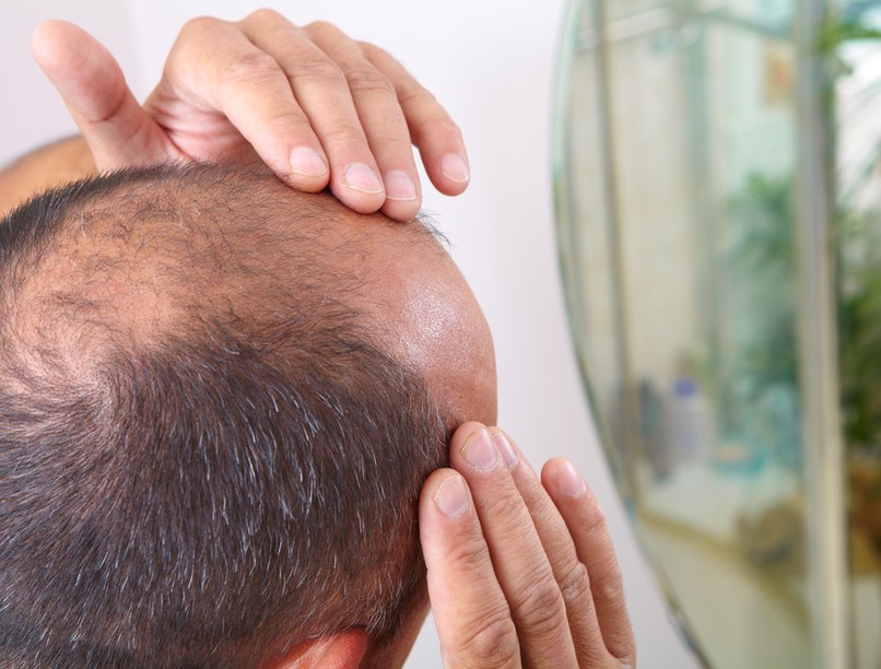 kopaszodás, hajhullás, kopaszodás ellenszere, hajszálak, szőrszálak