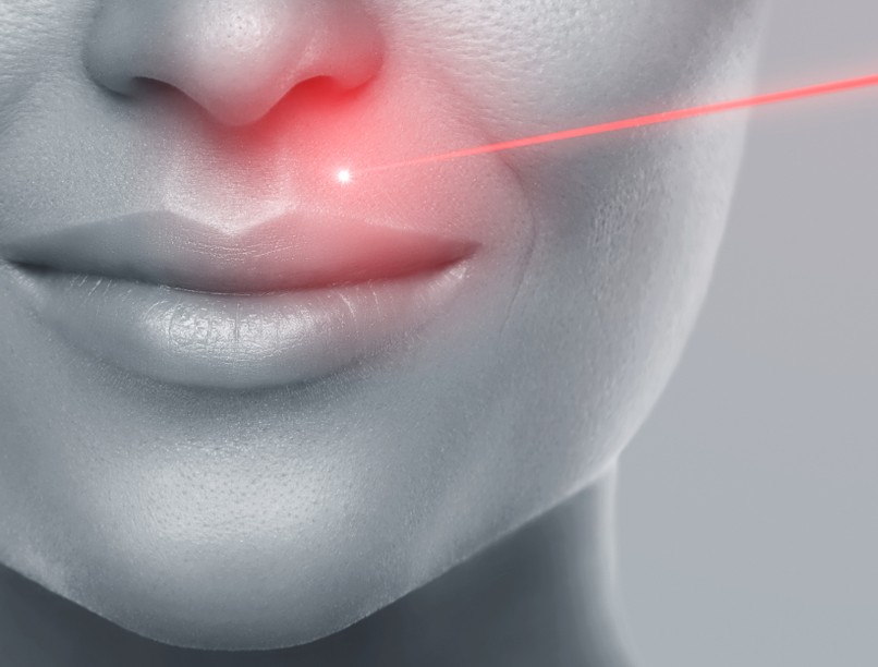 lézeres arcfiatalítás, kezelés, anti-ageing, frakcionált lézeres bőrfiatalítás