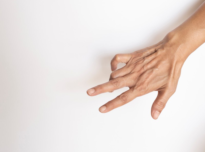 Dupuytren-kontraktúra: a kutatók szerint náluk nagyobb eséllyel alakulhat ki