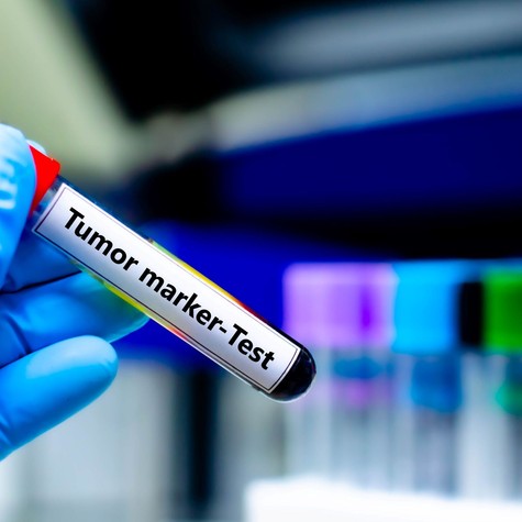 PSA, CA-125, CEA – Vajon mit jelentenek a leggyakoribb tumormarkerek? című cikk nyitóképe