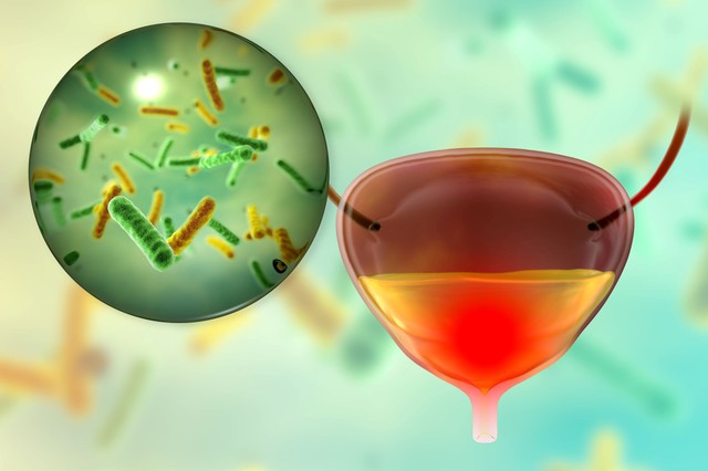 Húgyhólyaggyulladás: ezeket teheti a nászutasbetegség ellen