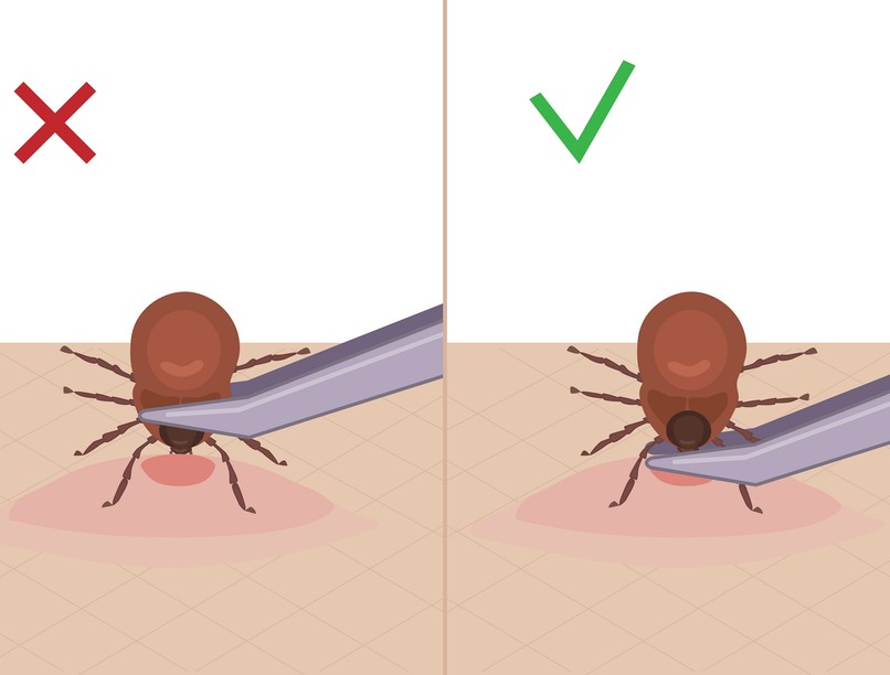 hogyan kell kiszedni kullancsot