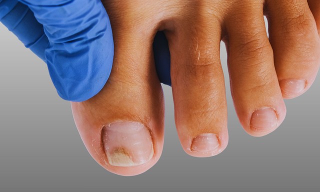 Elváltozások a körmön - innen tudhatja, hogy gomba vagy pikkelysömör okozza