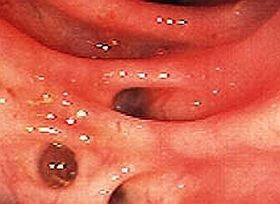 Divertikulum a bélrendszerben