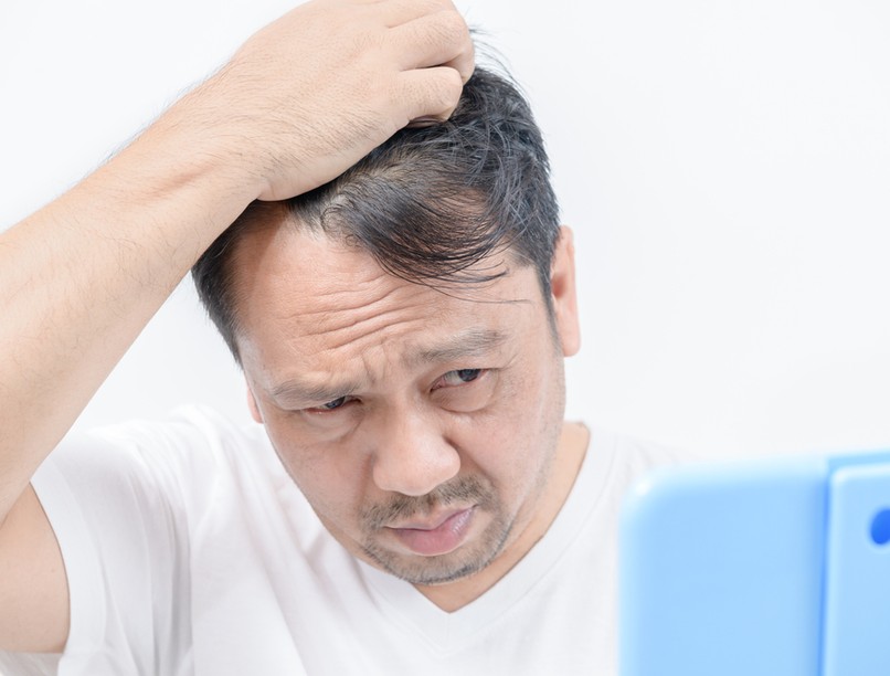 kopaszodás, férfiaknál, férfi hajhullás, biotin, tápanyag-pótlás