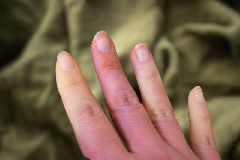 Ezért rosszabbodnak a Raynaud-szindróma tünetei hideg időben