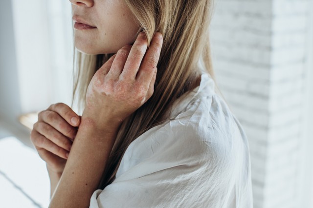 Ekcéma vagy pikkelysömör? Így különböztethető meg tünetek alapján a kettő