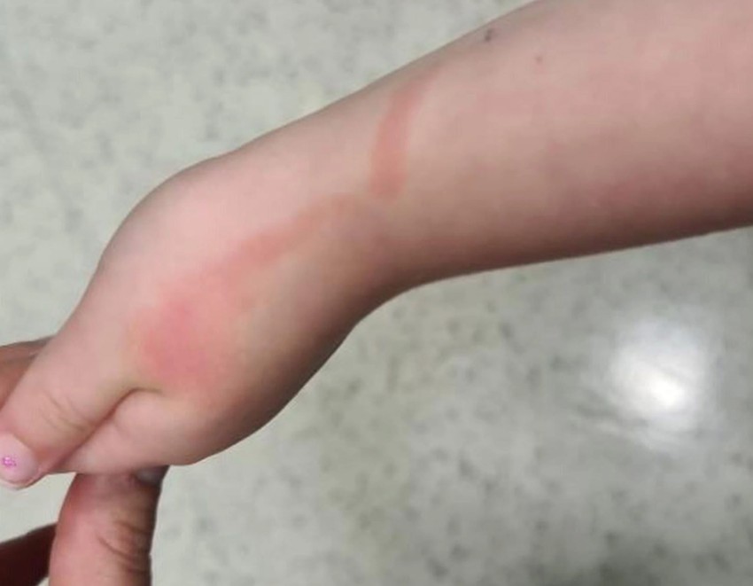 Már egy apró sérülés is végzetes következményekkel járhat.