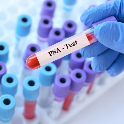 Normális PSA mellett is lehet prosztatarák? A gyakori teszt nagy félreértései című cikk nyitóképe