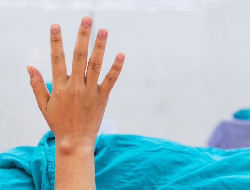 bőr alatti csomó jóindulatú rosszindulatú rák ciszta ultrahang