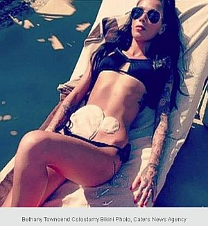 Kolosztomás zsák – és bikinis fotó: a bátorság dicsérete