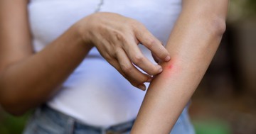 Ágyi poloska vagy pók csípte meg? Így döntheti el