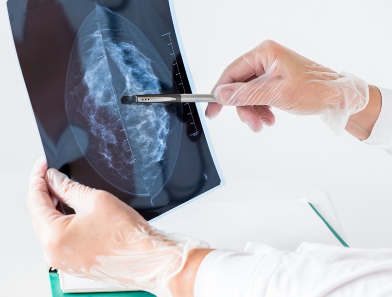 mellrák tünete emlőrák jele ajánlott vizsgálat nőknek