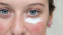 Rosacea és UV sugárzás: hogyan védekezzünk? című cikk nyitóképe