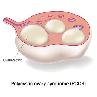 Policisztás ovárium szindróma tünetei, vizsgálata és kezelési lehetőségei című cikk nyitóképe