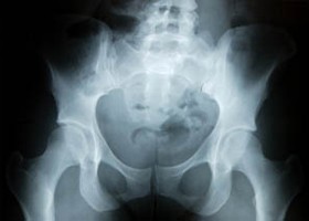 Újdonságok a protetikában