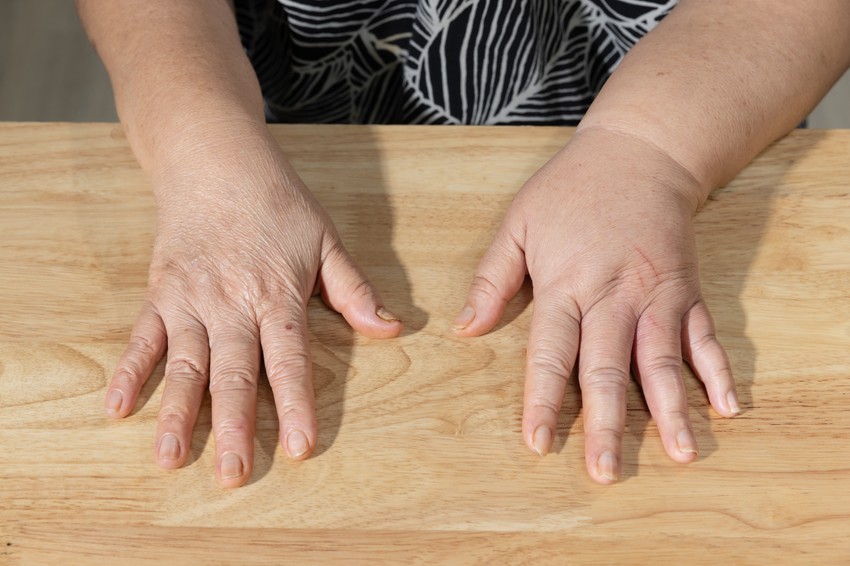 A nyiroködéma a kézfejen, kézháton, továbbá az ujjakon, illetve lábujjakon jelenhet meg először, innen terjed ezt követően a csuklón át a karok, illetve a bokán át a combok irányába.